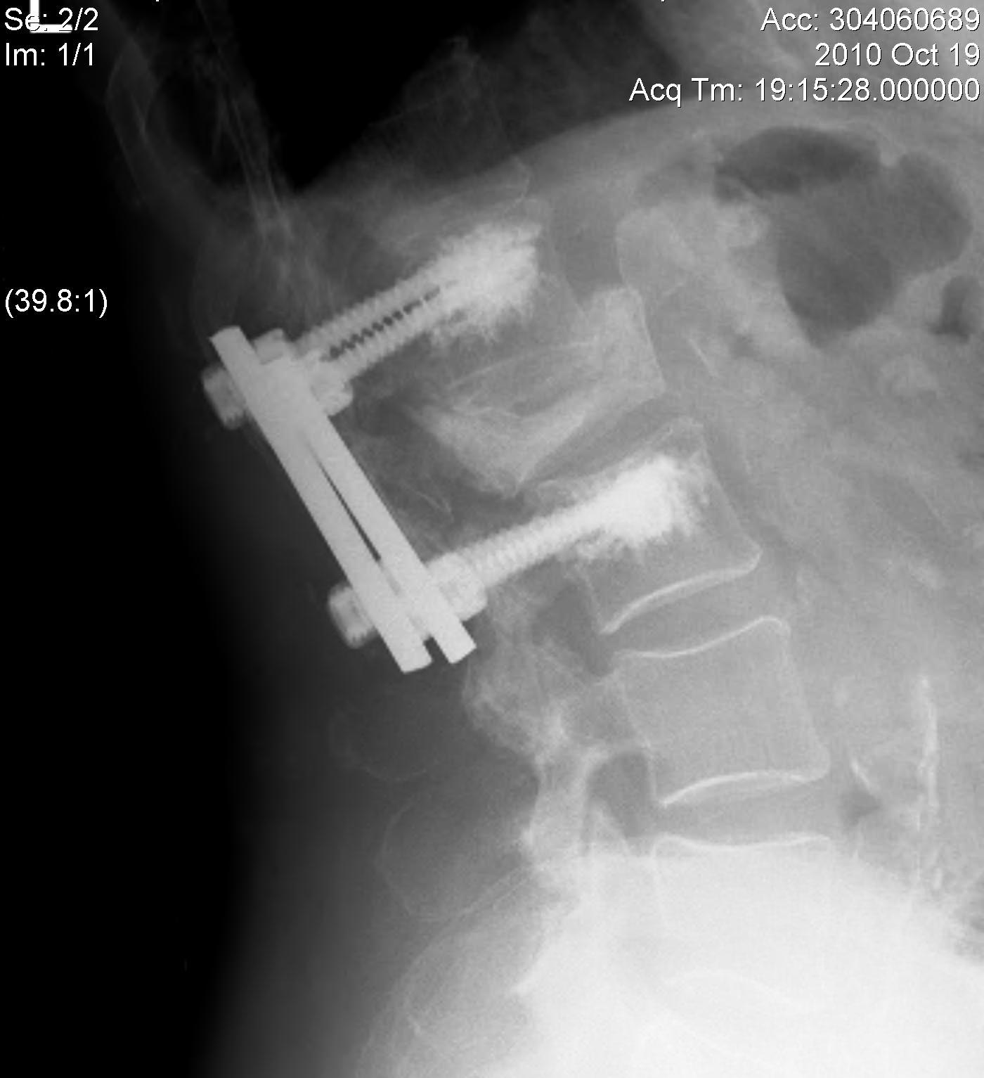 Lumbar Metastasis Posterior Stabilisation with PMMA